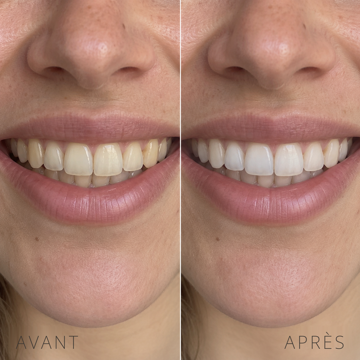 Kit de Blanchiment Dentaire LED — Sourire Éclatant en 15 Minutes
